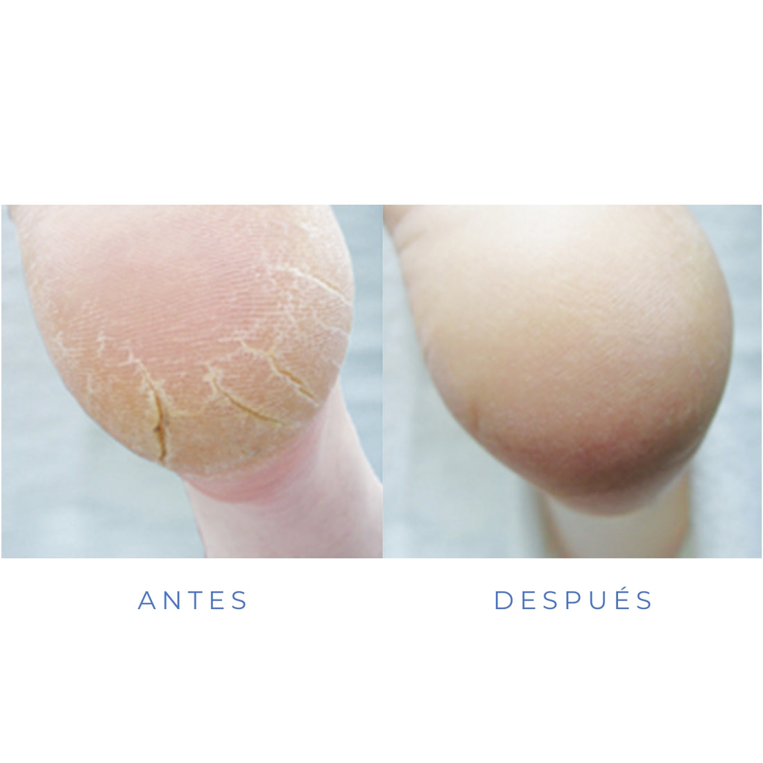 Mousse para talĂłn agrietado 125 Ml Footlogix